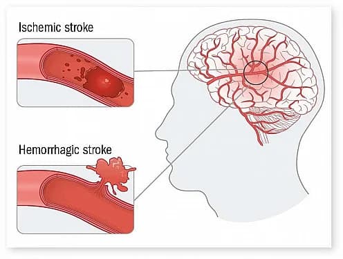 Cover Image for Stanford Researchers Unravel Stroke Causes for Communities